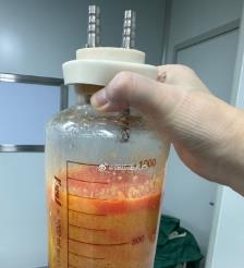 伊川水动力吸脂手术要做多久？